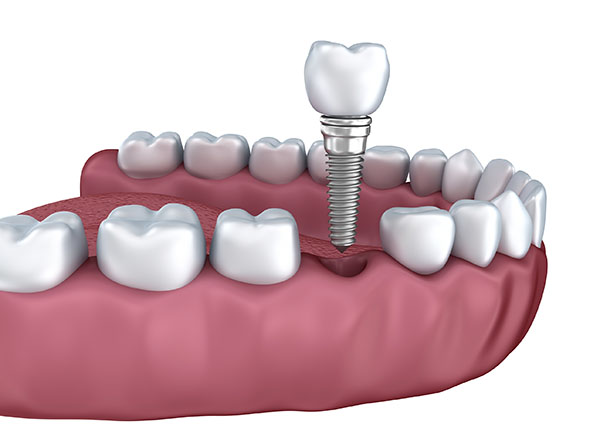 dental-services-implants